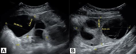 ovarian torsion tests|ovarian torsion after hysterectomy.